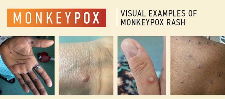 Images of monkeypox rash